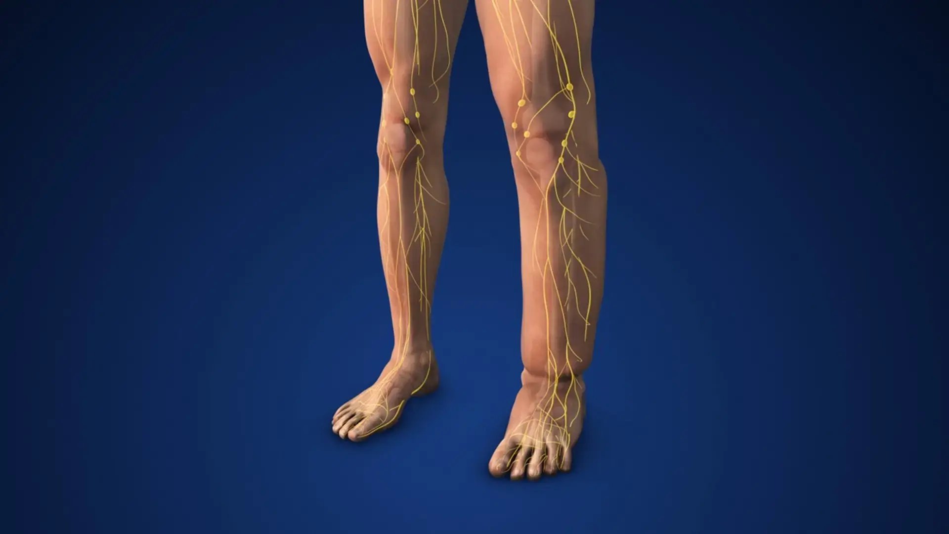 Lymphedema is a condition characterized by swelling due to the accumulation of lymph fluid in the tissues